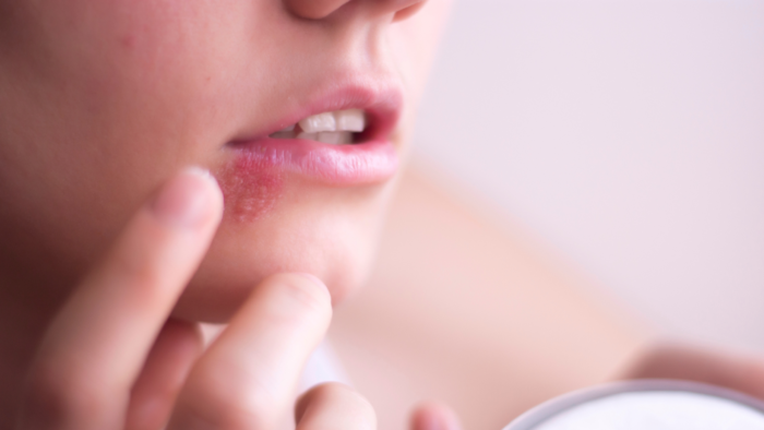 esenciální oleje na opar, herpes